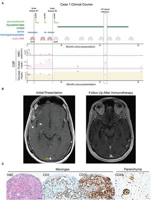 Dual ankyrinG and subpial autoantibodies in a man with well-controlled HIV infection with steroid-responsive meningoencephalitis: A case report